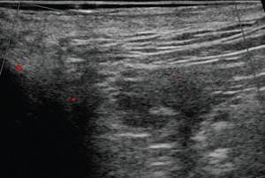 Ultrasound of the soft tissues of the perineum (CDC mode) - 3 months after surgery, the vascular pattern in the subcutaneous fatty tissue in this projection is not enriched