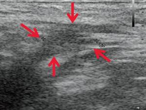Ultrasound of the soft tissues of the perineum (B-mode) - 14 days after surgery, the hypoechoic liquid formation in the perianal area decreased in size (b)
