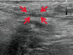 Ultrasound of the soft tissues of the perineum (B-mode) - 14 days after surgery, the fistula tract has decreased in size (arrows)