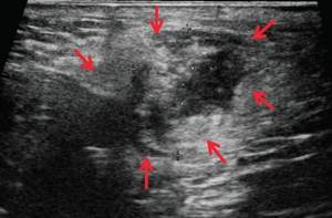 Ultrasound of the soft tissues of the perineum (B-mode) - 3 days after surgery (b)
