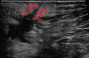 Ultrasound of the soft tissues of the perineum (B-mode) - 3 days after surgery, the fistula tract decreased in size (arrows)