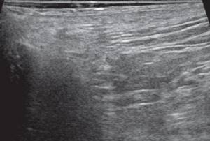 Ultrasound of the soft tissues of the perineum (B-mode) - 3 months after surgery, a fluid formation with a fistulous tract in the subcutaneous fat is not clearly visualized
