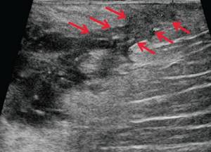 Ultrasound of the soft tissues of the perineum (B-mode) - along the periphery of the formation closer to the gluteal region - a developing fistulous tract (arrows)