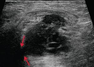 Ultrasound of the soft tissues of the perineum (B-mode) - a hypoechoic liquid formation is determined in the perianal area on the left at a depth of 0.6 cm from the surface of the skin (b)