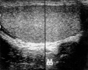 Ultrasound: Normal testicle