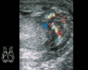 Ultrasound: Acute epididymitis, CDK