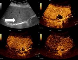 Liver ultrasound interpretation
