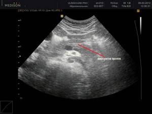 Ultrasound of the pancreas: duct of Wirsung
