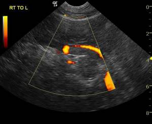 Ultrasound of the pancreas