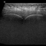 Ultrasound symphysitis