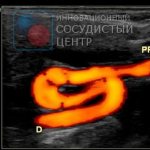 Ultrasound of the carotid arteries for tortuosity