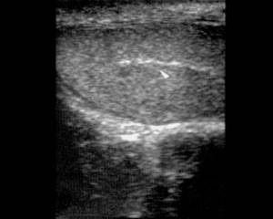 Ultrasound: Mediastinum testis