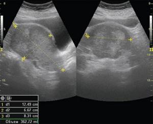 Ultrasound, B-mode, transabdominal scanning, stage IV endometrial cancer