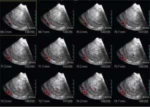 Ultrasound performed using Multi-slice view technology, in layer-by-layer sections it becomes possible to accurately determine the structure of the endometrium and its vascularization