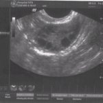 Ultrasound: ovaries are normal
