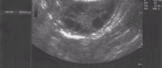 Ultrasound: ovaries are normal