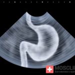 Ultrasound of the stomach