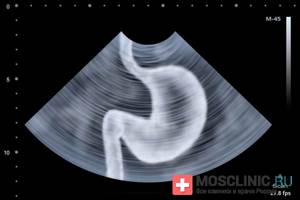 Ultrasound of the stomach