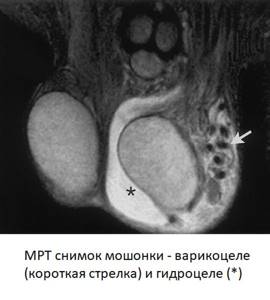 Varicocele on MRI of the scrotum