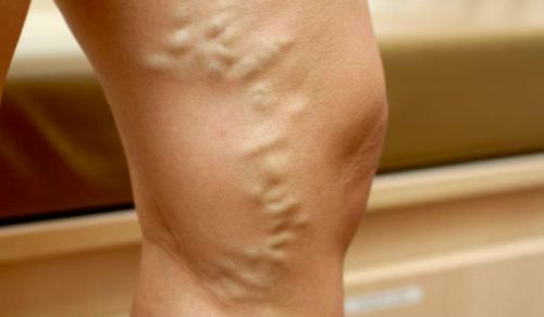 Varicose veins of the legs