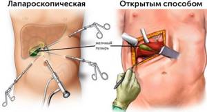 Types of cholecystectomy
