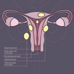 types and types of uterine fibroids