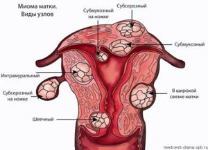 types of uterine fibroids