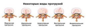 Types of intervertebral disc protrusions