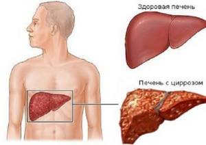 types of liver cell diseases