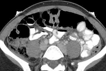 Visualization of internal organs on CT with contrast - when taking the solution orally