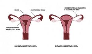 Ectopic pregnancy.jpg