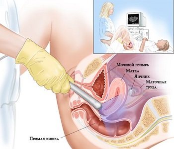 Doctor performing vaginal ultrasound on woman