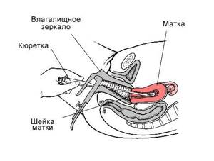 Curettage of the uterine cavity