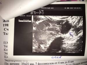 ovary on ultrasound