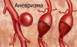Заболевание аневризма аорты