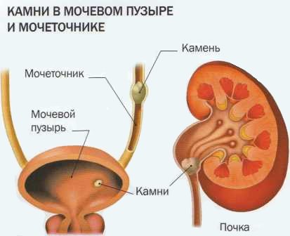 Urinary retention in the bladder can occur due to obstruction of the bladder outlet by a stone.