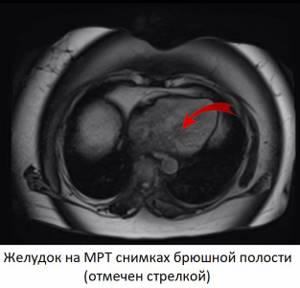 Stomach on MRI image