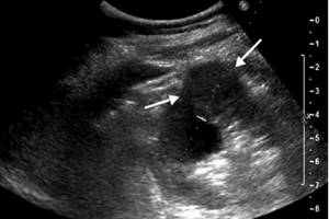 Malignant tumor in the kidney on ultrasound